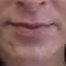 Lip augmentation - cheiloplasty