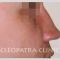 Rhinoplasty (Nose Job)