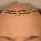 Hair Transplant