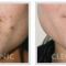 Laser procedures in aesthetic dermatology