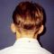 Ear surgery (Otoplasty)