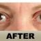 Botulinum toxin - Wrinkle Removal