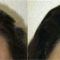Hair Transplant