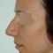 Rhinoplasty (Nose Job)