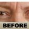 Botulinum toxin - Wrinkle Removal