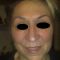 Eyelid surgery (Blepharoplasty)