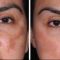 Mesotherapy (face, neck revitalization)