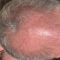 Hair Transplant