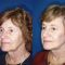 Facelift