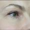 Hyaluronic acid-based wrinkle fillers