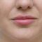 Lip augmentation - cheiloplasty