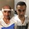 Hair Transplant