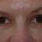 Hyaluronic acid-based wrinkle fillers