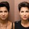 Botulinum toxin - Wrinkle Removal