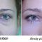 Laser procedures in aesthetic dermatology