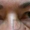 Eyelid surgery (Blepharoplasty)