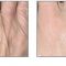 Mesotherapy (face, neck revitalization)