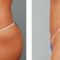 Liposuction alternative – non-invasive fat and cellulite removal