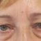 Eyelid surgery (Blepharoplasty)