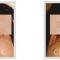 Rhinoplasty (Nose Job)