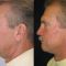 Facelift