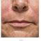 Botulinum toxin - Wrinkle Removal
