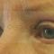 Eyelid surgery (Blepharoplasty)