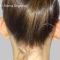 Ear surgery (Otoplasty)