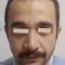 Hair Transplant