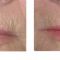 Fotorejuvenation