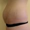 Abdominoplasty (Tummy Tucks)
