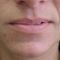 Lip augmentation - cheiloplasty