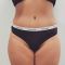 Abdominoplasty (Tummy Tucks)