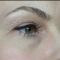Hyaluronic acid-based wrinkle fillers