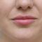 Lip augmentation - cheiloplasty