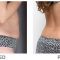 SlimLipo Laser Liposuction