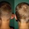 Ear surgery (Otoplasty)