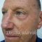 Rhinoplasty (Nose Job)