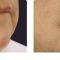 Fotorejuvenation
