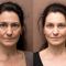 Botulinum toxin - Wrinkle Removal