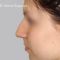 Rhinoplasty (Nose Job)