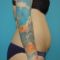Abdominoplasty (Tummy Tucks)