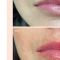 Lip augmentation - cheiloplasty