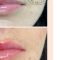 Lip augmentation - cheiloplasty