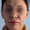 Facelift
