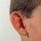 Ear surgery (Otoplasty)