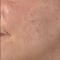 Fractional Laser Resurfacing