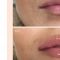Lip augmentation - cheiloplasty