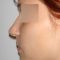 Rhinoplasty (Nose Job)