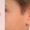Ear surgery (Otoplasty)